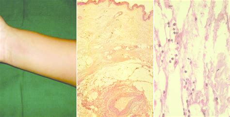 (a) Ill-defined area of induration with overlying skin showing mild ...