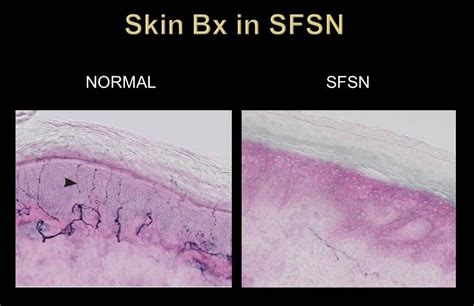 ENFD - Skin Punch Biopsy testing for Small Fiber Neuropathy — MedWORX ...