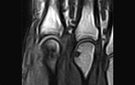 Assessing the Diagnostic Accuracy of MRI in Early Rheumatoid Arthritis - Rheumatology Advisor