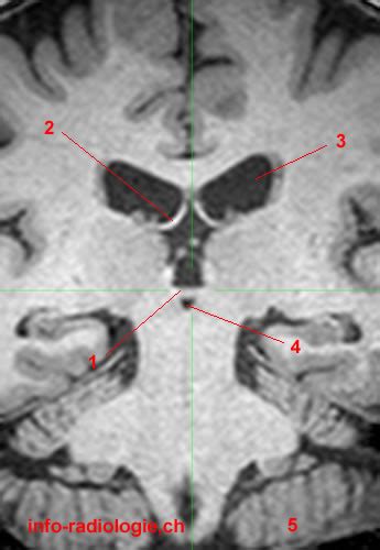 Anterior Commissure - Posterior Commissure - W-Radiology