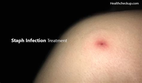 Staph Infection Treatment | Symptoms of Staph Infection | Health Checkup