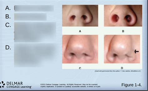 Nasal Flaring Diagram | Quizlet