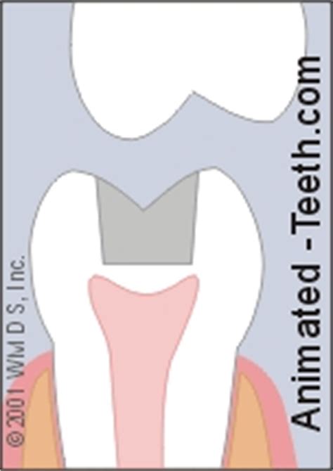 Broken and cracked teeth. Problems & Symptoms. How they’re repaired.