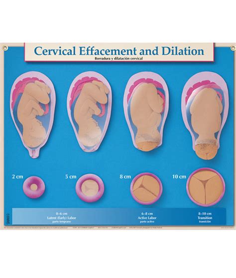 Cervical Effacement and Dilation Poster