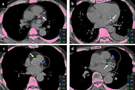 Frontiers | Validation of deep learning-based fully automated coronary artery calcium scoring ...