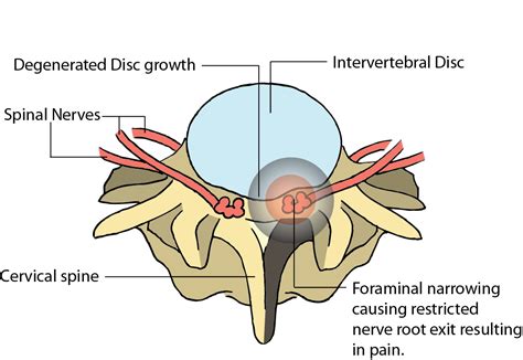 Cervical Foraminal Stenosis - Cervical Narrowing & Spine Condition - Dr. Rahul Shah