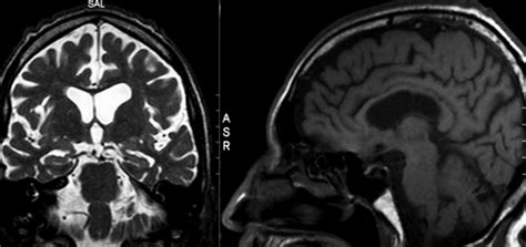 Brain MRI showing: [A] (T2-weighted coronal section) mild hippocampal... | Download Scientific ...