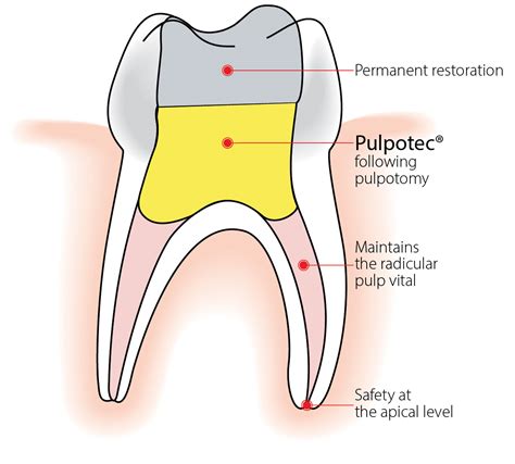 Pulpotec® - Your solution for pulpotomy treatment | Swiss product