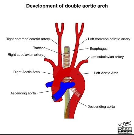 Development of double aortic arch (illustration) | Radiology Case | Radiopaedia.org