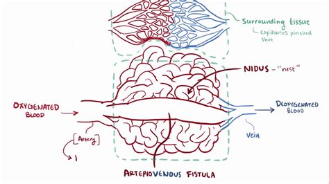 Arteriovenous malformation AVM causes, symptoms, diagnosis, & pathology ...