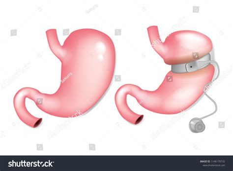 Gastric Band Before After Gastric Banding Stock Vector (Royalty Free ...