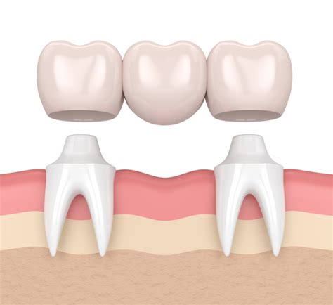 Describe the Uses of Porcelain for Fixed Prosthodontics - Kylee-has-Gibbs