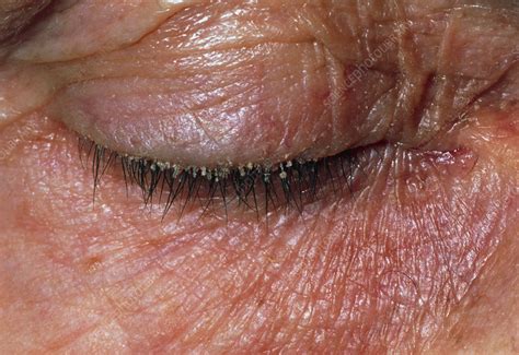 Blepharitis or inflammation of the eyelid - Stock Image - M155/0401 - Science Photo Library