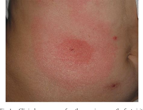 Figure 1 from Erythema migrans associated with Amblyomma testudinarium ...