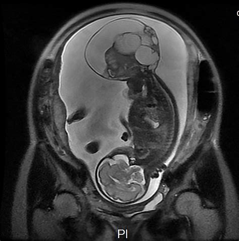 Sacrococcygeal Teratoma In Adults