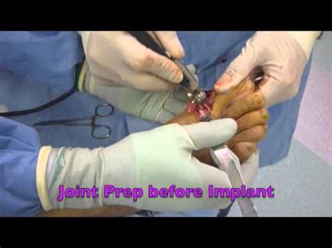 Big Toe Joint Implant Surgery For Arthritis By San Francisco Podiatrist