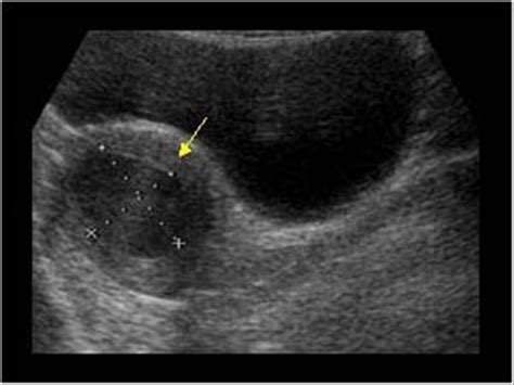 Gynaecology | 3.1 Uterus : Case 3.1.2 Miscellaneous benign uterine and ...