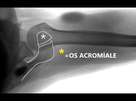 Os acromiale. (A rare cause of shoulder pain) - YouTube