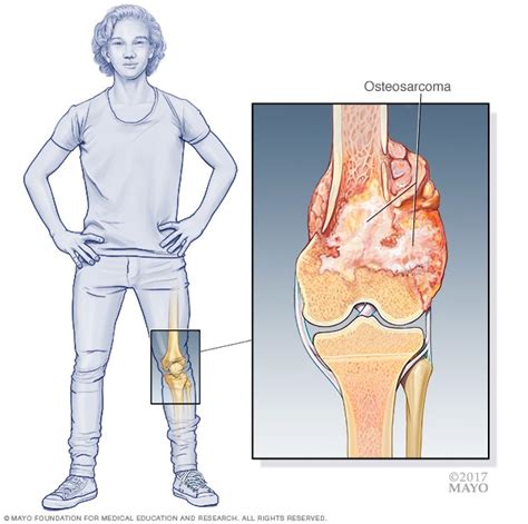 Osteosarcoma - Symptoms and causes - Mayo Clinic