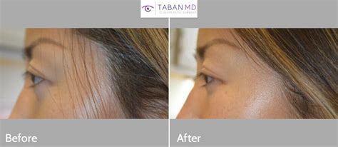 Almond Eye Surgery Before and After Gallery | Taban MD