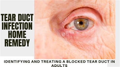 tear duct infection home remedy | Identifying and Treating a Blocked Tear Duct in Adults - YouTube