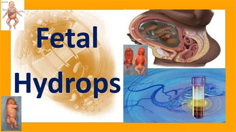 Fetal Hydrops | Hydrops Fetalis | Fetal Hydrops Causes, Complications, Treatment and Prognosis ...