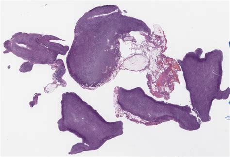 Marginal Zone Lymphoma Minimally Involving the Lymph Node With Focal ...