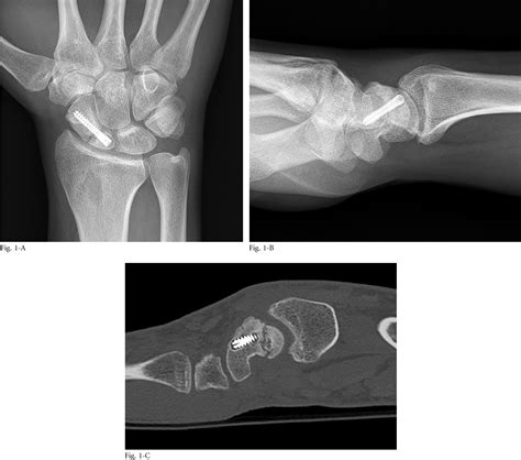 Figure 1 from Free Vascularized Medial Femoral Condyle Bone Graft After ...