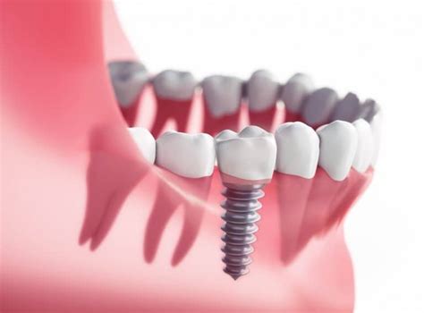 How Dental Implants Reduce Your Risks of Future Tooth Loss | Encinitas, CA