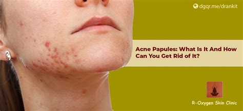 Acne Papules: What Is It And How Can You Get Rid of It?