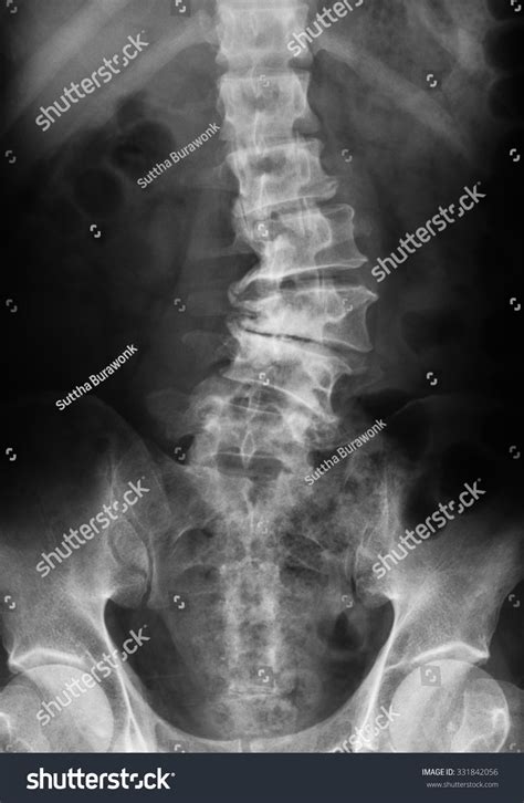 X-Ray Image Of Lumbosacral Spine Showing Osteoarthritis Of Lumbar. Stock Photo 331842056 ...