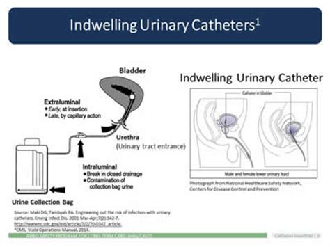 Urinary Catheter Types and Being Part of the Insertion Team | Agency ...