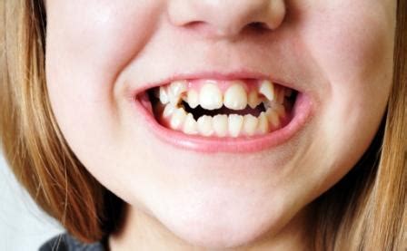 Why Braces Are Important for Children With Crooked Teeth