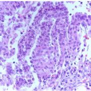 Omental biopsy showing metastatic deposits of invasive low-grade serous... | Download Scientific ...