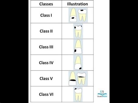 Dr G V Blacks Classification Of Dental Caries And Restorations – Otosection