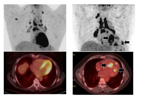 High-fat diet before imaging improves diagnosis of cardiac sarcoidosis ...