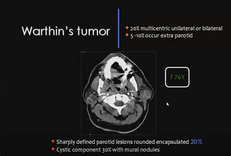 Warthin's Tumor | Head and neck, Tumor, Radio