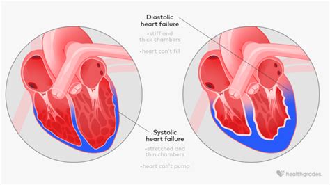 Systolic Vs. Diastolic Heart Failure: Symptoms, Causes, Treatments