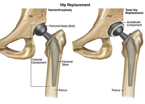 Choosing a Best Hip Replacement Implants | Dr. Santosh Shetty