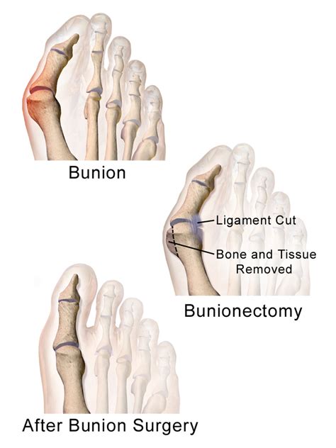 Bunion Surgery