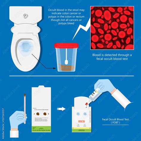 Fecal occult blood test FOBT lab stool sample bleeding screen risk examination collect container ...