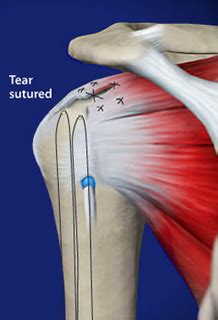 Rotator Cuff Surgery | Seaside Surgery Center