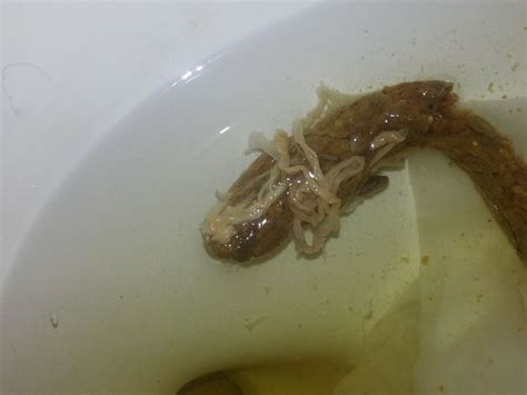 Human Pinworm In Stool