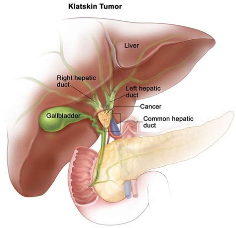 Klatskin tumor causes, symptoms, diagnosis, treatment & prognosis