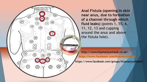 64 Hijama points ideas | hijama, hijama points, cupping therapy