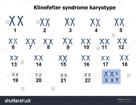 Klinefelter Syndrome Karyotype庫存插圖 263682395 | Shutterstock