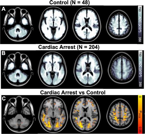 Regional distribution of anoxic brain injury after cardiac arrest ...