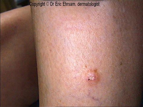 dermoscopy: Dermatofibroma