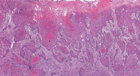 Squamous cell carcinoma of the oral cavity | MyPathologyReport.ca