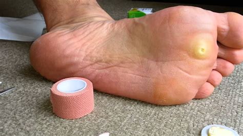 best way to get rid of corns on ball of foot...great idea! Just be sure to keep the crushed ...